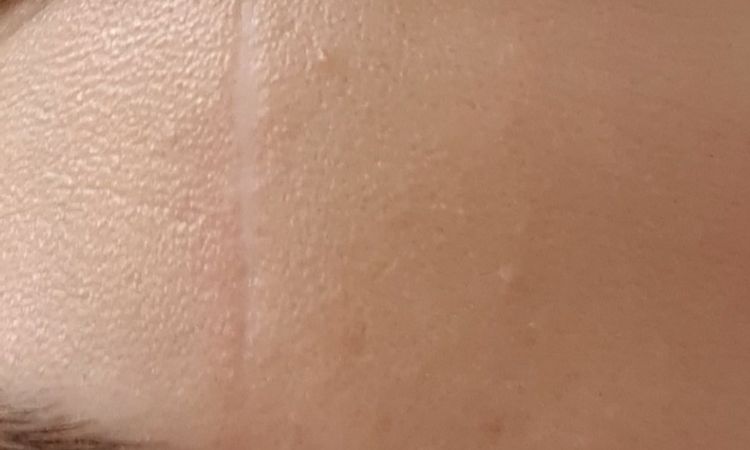 Cicatrice di 10 mesi - 21224