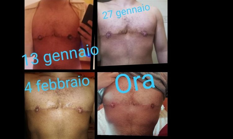 Come sta procedendo l'operazione di mastectomia - 21246