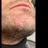 Cicatrice sul mento e problema barba - 21254