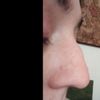 Callo osseo sul naso dopo ferita da morso - 25192