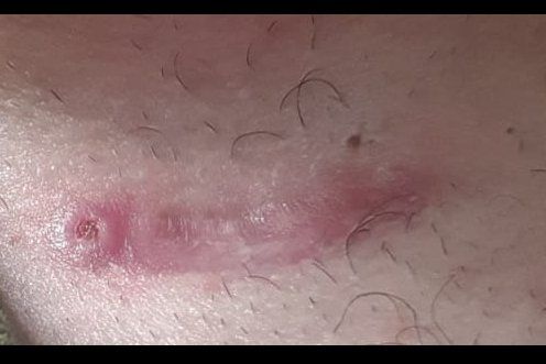 Laser DYE per cicatrice post intervento chirurgico - 25257