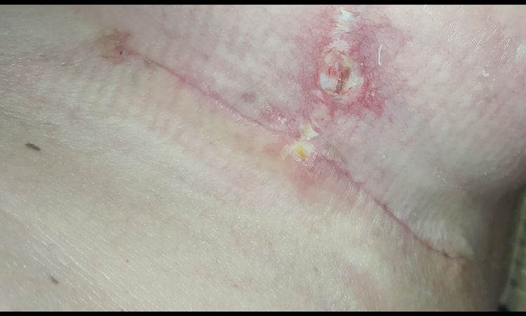 Cicatrice con pus mastopessi - 25306
