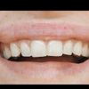 Grumi e irregolarità filler labbra dopo tre giorni - 32401