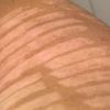 depilazione su spalle con macchie date da assenza di melanina