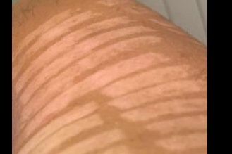 depilazione su spalle con macchie date da assenza di melanina - 32493