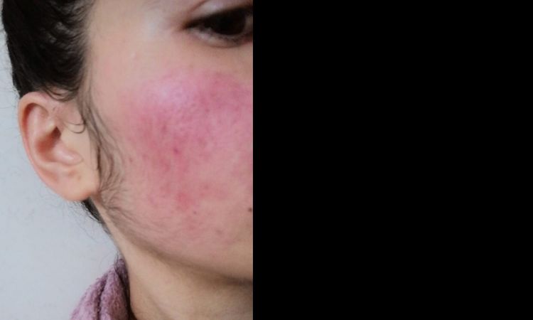 Rosacea teleangectas - 32553