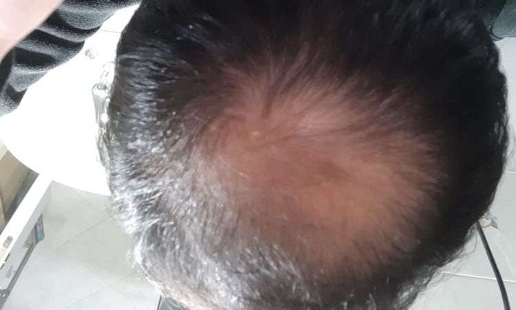 per aiutare la crescita dei capelli posso farmi il prp ? - 32604