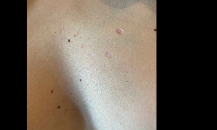 Cicatrici atrofiche sul decolletè post rimozione angiomi rubini - 32619