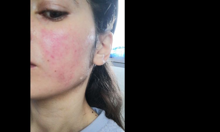 Rosacea teleangectasica - 32700