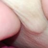 Piccola escrescenza interno coscia