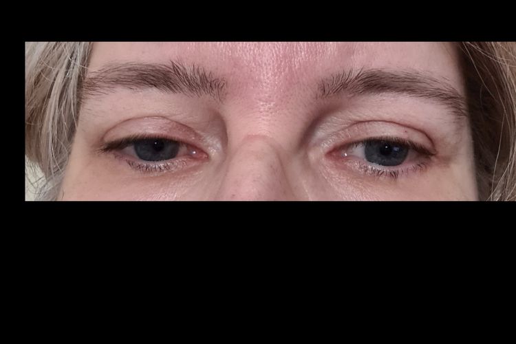 Ritocco post blefaroplastica solo un occhio - Guidaestetica.it