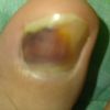 Problema con le unghia del piede - 32829