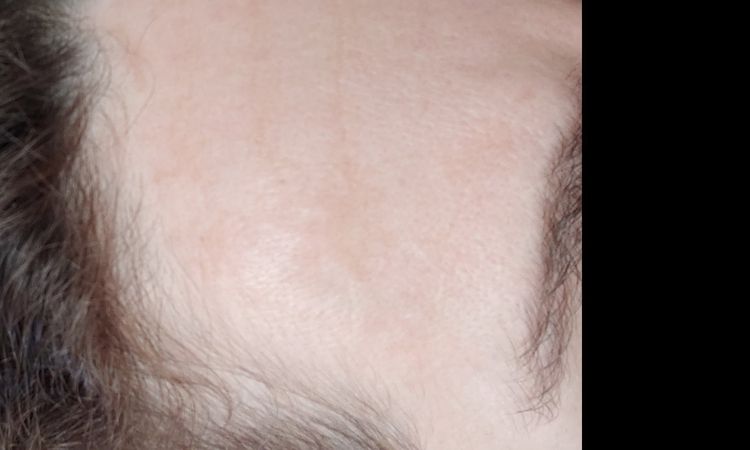 Melasma o iperpigmentazione? - 32854