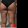 Criolipolisi per interno coscia?