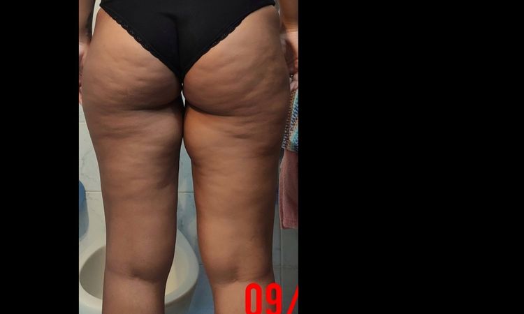 Criolipolisi per interno coscia? - 32880