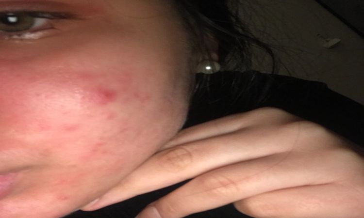 Pelle che brucia, si squama e provoca dolori - 33134