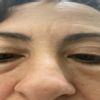 Borse enormi sotto gli occhi dopo filler acido ialuronico, cosa devo fare??