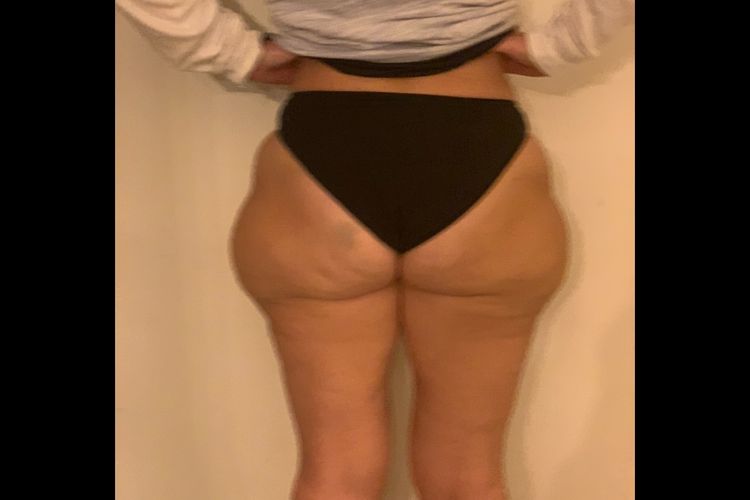 Criolipolisi Con coolsculting per adiposità da lipedema sui glutei