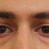 Borse sotto gli occhi e befaroplastica inferiori - 33214