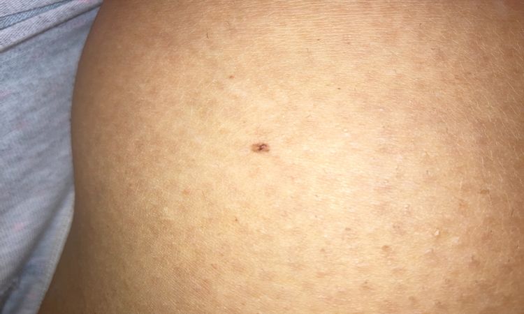 Neo bruciato epilazione laser - 33218