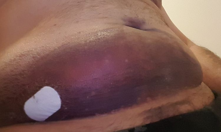 Ematoma assurdo dopo piccolissima liposuzione - 33419