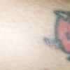 Bruciatura laser del tatuaggio - 33622