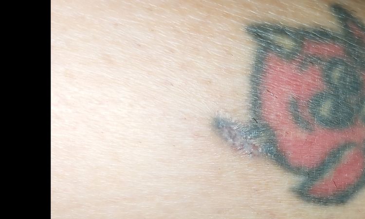 Bruciatura laser del tatuaggio - 33622