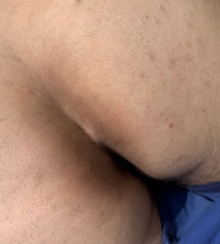 Piega natiche ano scura
