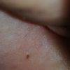Piccolo neo interno coscia