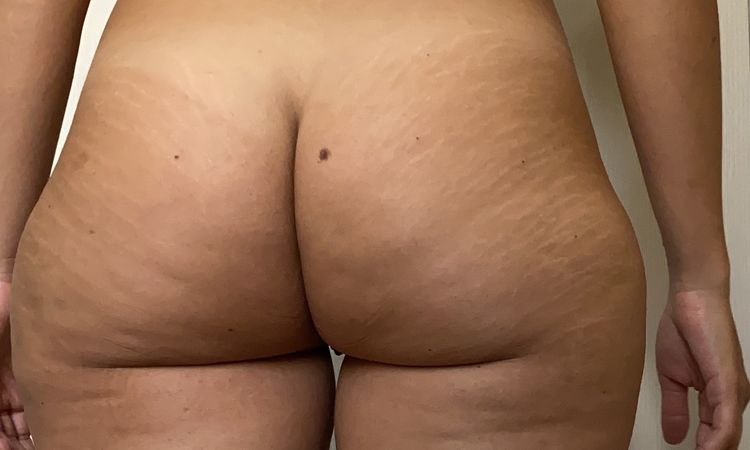 Liposcultura in presenza di smagliature - 42986