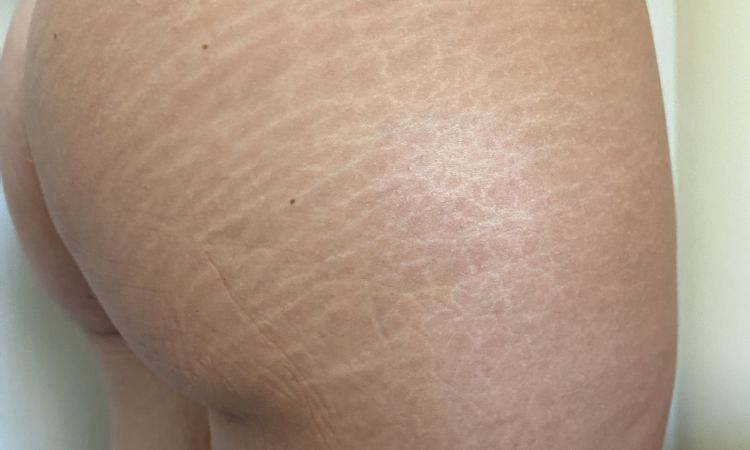 Liposcultura in presenza di smagliature - 42987