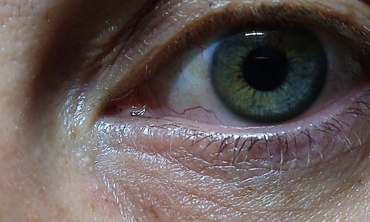 Asportazione neo, meglio laser o chirurgia? - 43171