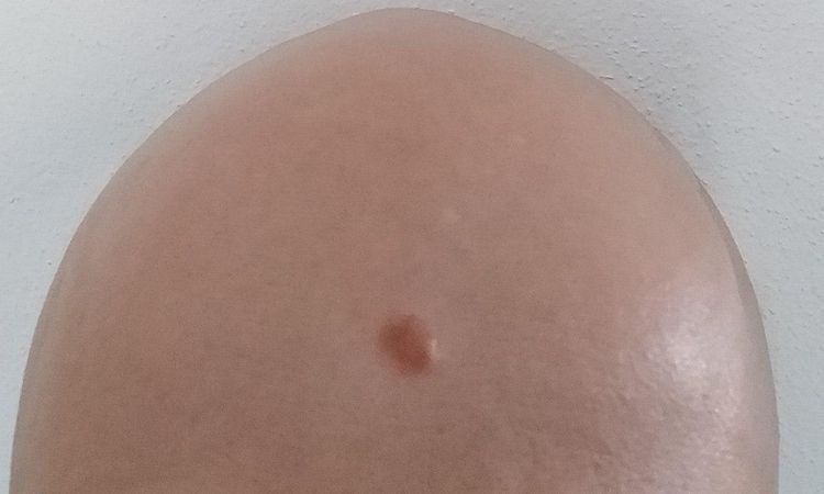 Asportazione neo sulla parte alta della fronte dermatologo o chirurgo estetico? - 43255