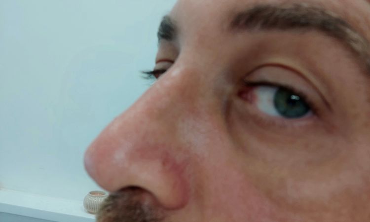 Rinosettoplastica punta verso il basso, consigli? - 43318