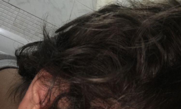 Alopecia solo su un lato? - 43490