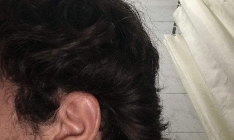 Alopecia solo su un lato? - 43492