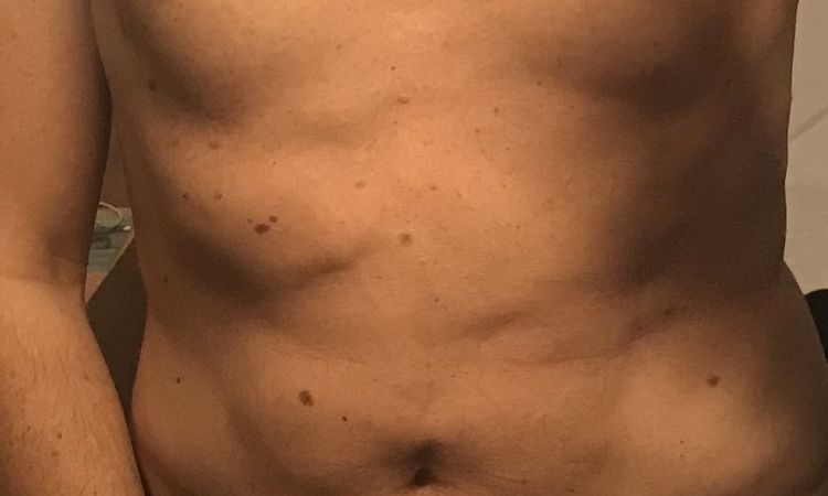 Edemi e/o fibrosi post liposuzione, 5 mesi dopo? - 43682