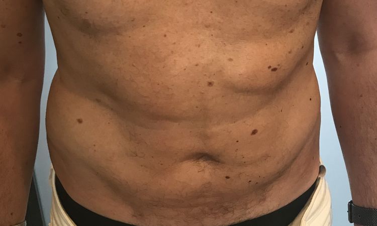 Edemi e/o fibrosi post liposuzione, 5 mesi dopo? - 43683