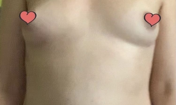 Protesi per seno distante con effetto naturale - 43809