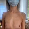 Mastoplastica additiva sottoghiandolare è consigliabile per ragazze magre?