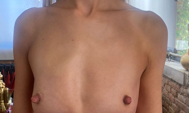 Mastoplastica additiva sottoghiandolare è consigliabile per ragazze magre? - 43939