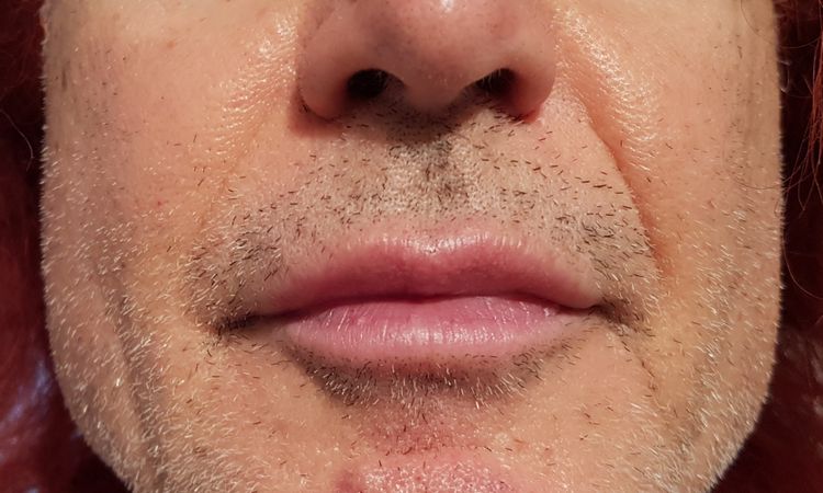 Per rimuovere la barba bianca che laser è consigliabile? - 44005