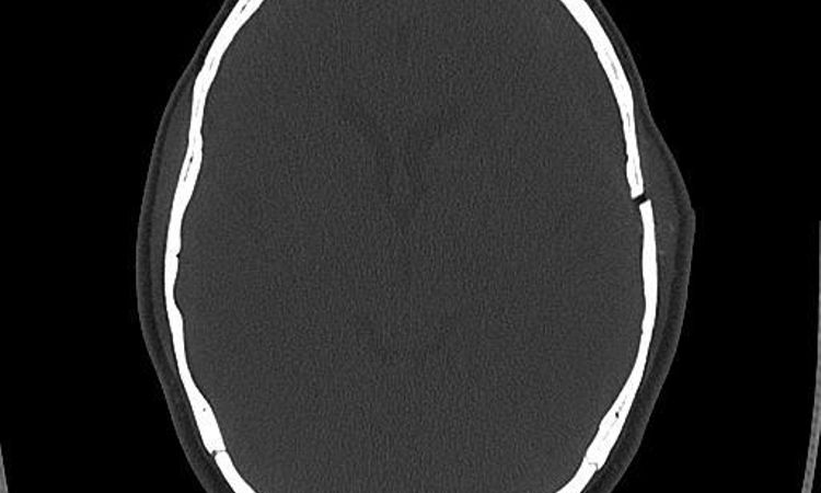 Infossamento sulla tempia dovuto a una craniotomia - 44162