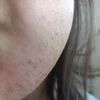 Puntini rossi e gonfiore dopo depilazione laser al viso - 44188