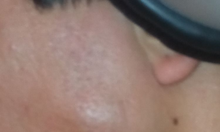 Ramus corto si può allungarlo con protesi - 44359