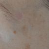 Macchia rosa post laser