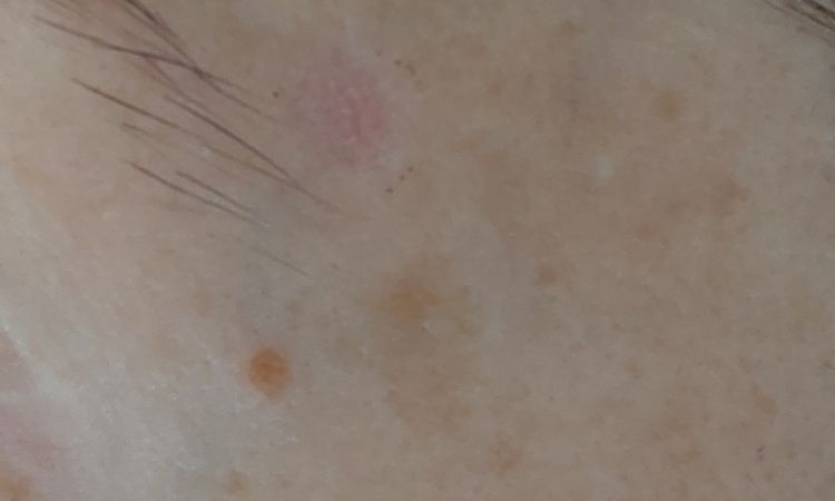 Macchia rosa post laser - 44423