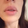 Fibrosi labbra o residui accumuli - 44736