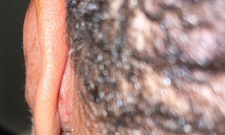 Otoplastica: quanto dura il post operatorio? - 44905