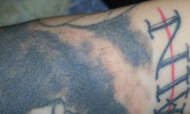 Post laser rimozione tatuaggi - 44983